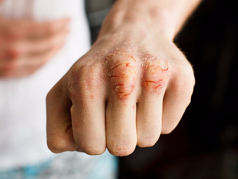 [عکس: Womens-hand-eczema3.jpg]