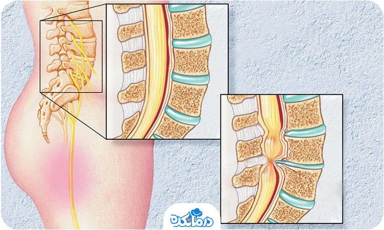 تصویر تنگی کانال نخاعی