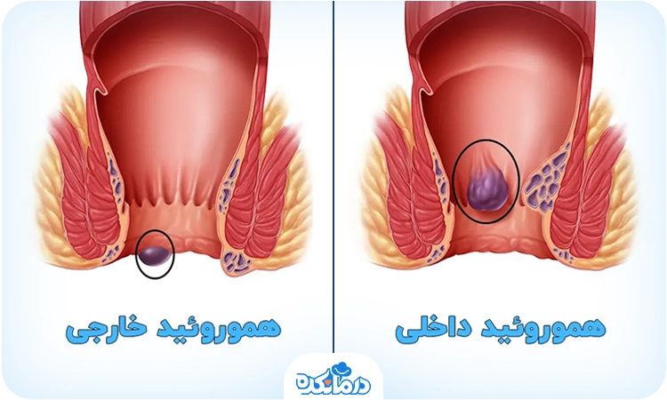  تصویر گرافیکی از هموروئید داخلی و خارجی
