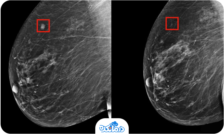 تصویر توده سرطانی سینه در ماموگرافی