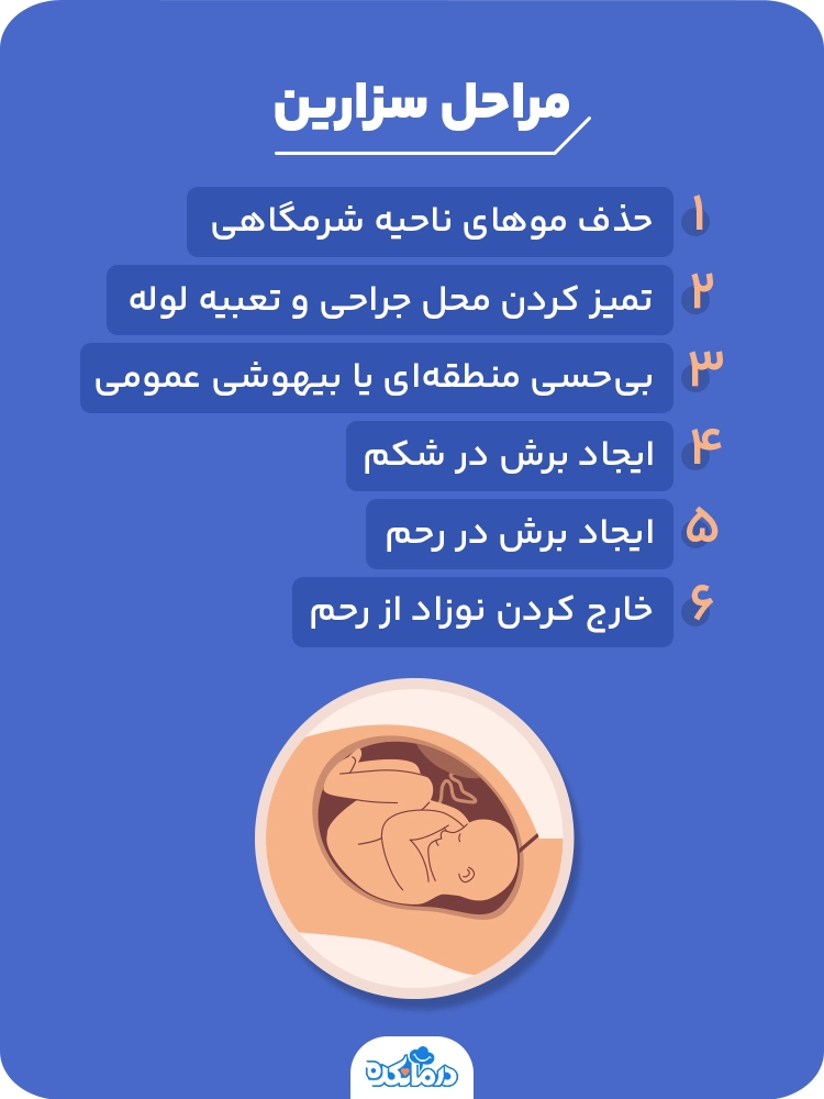 اینفوگرافی درباره مراحل زایمان سزارین