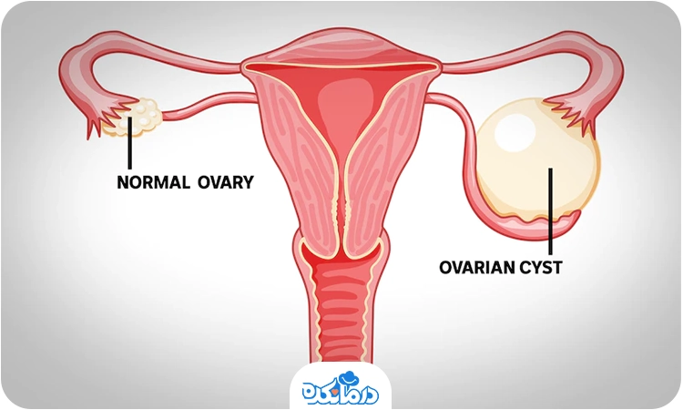 تصویر گرافیکی از تخمدان سالم و دارای کیست