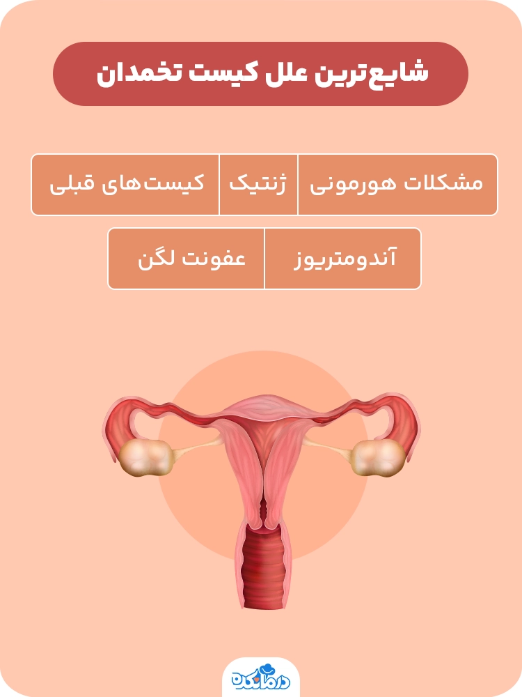  شایع‌ترین علل کیست‌ تخمدان 