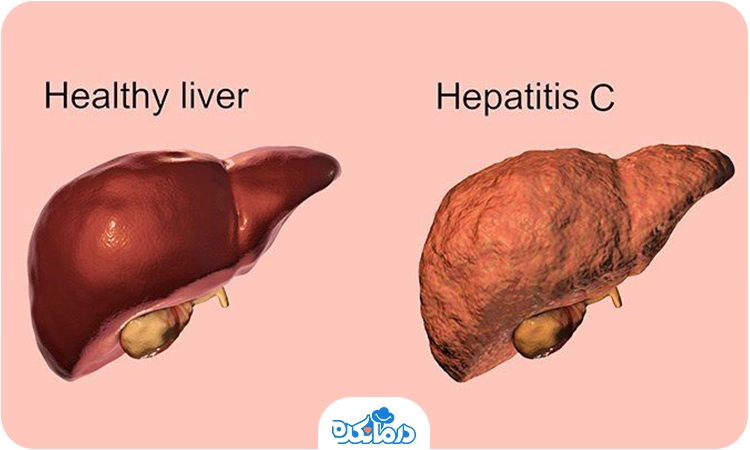  تصویری از کبد سالم و مبتلا به هپاتیت C