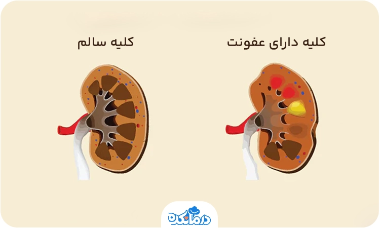 تصویری از کلیه دارای عفونت و سالم