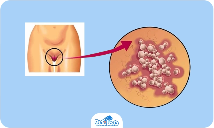 تصویر گرافیکی از تبخال تناسلی