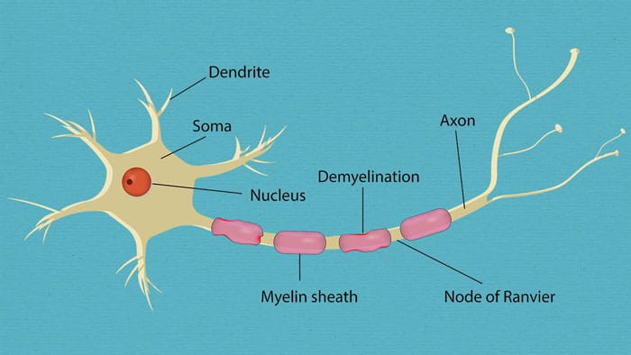 تصویری از یک سلول عصبی و غلاف میلین روی اعصاب که تخریب شده است
