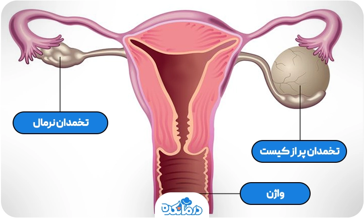 تخمدان پر از کیست