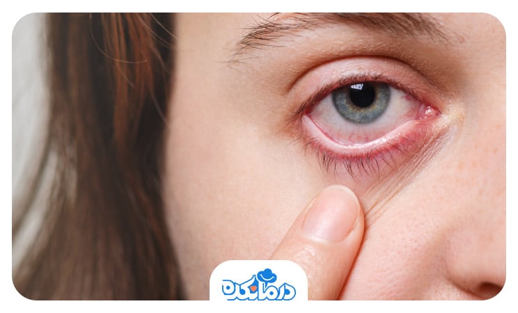 تصویر زنی که چشمش دچار عفونت و بیماری شده است