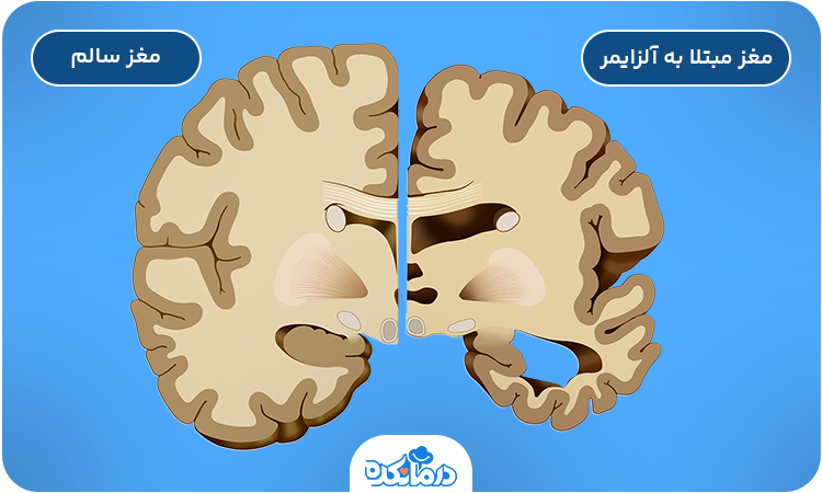 تصویری از مغز سالم و مبتلا به آلزایمر