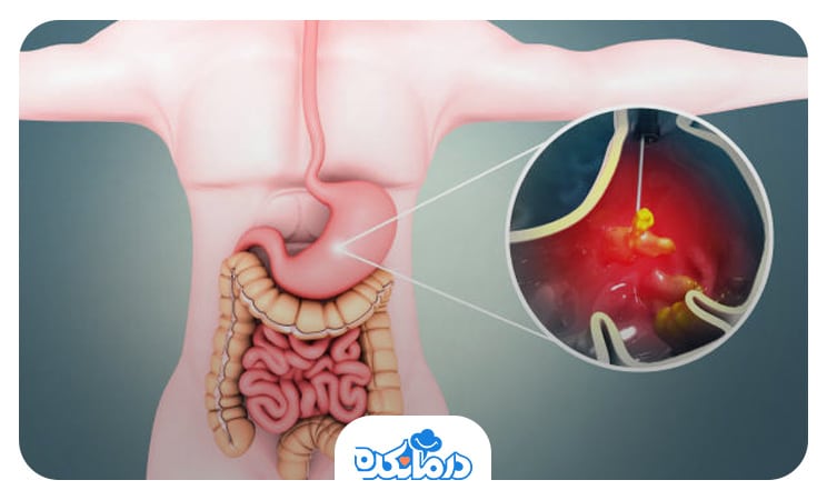 تصویر گرافیکی را می‌بینید که زخم معده و کرامپ معده را نشان می‌دهد.