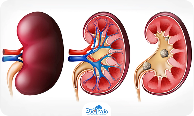  تصویر گرافیکی از کلیه سالم و دارای سنگ