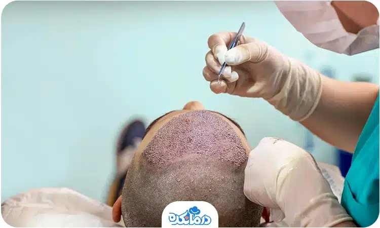 یک پزشک در حال جراحی کاشت مو