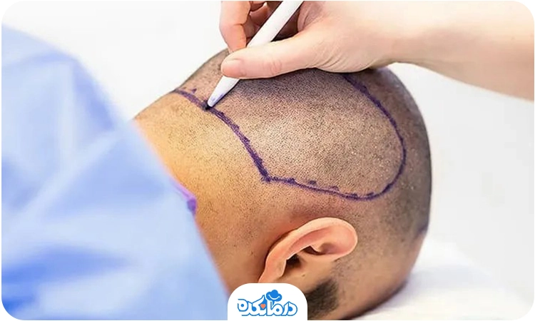یک مرد که روی سر او جراحی کاشت مو انجام می‌شود