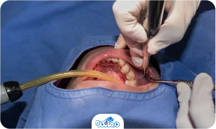 تصویر یک فرد در حال جراحی دندان با بی‌هوشی عمومی