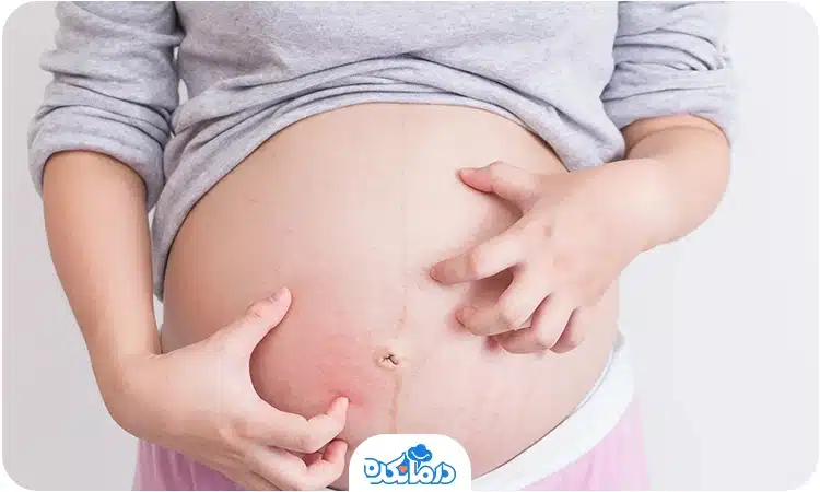  یک زن باردار در حال خاراندن شکم