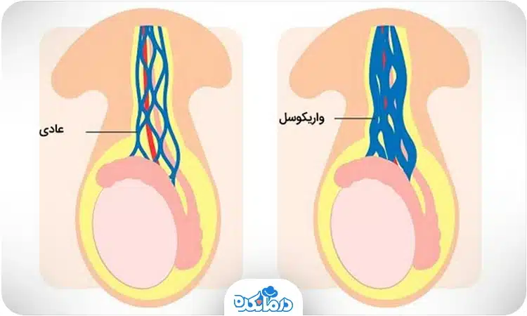 تصویر گرافیکی از رگ‌های گره‌خورده بیضه ناشی از واریکوسل