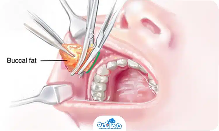 تصویر گرافیکی از ایجاد برش داخل دهان برای خارج کردن چربی بوکال