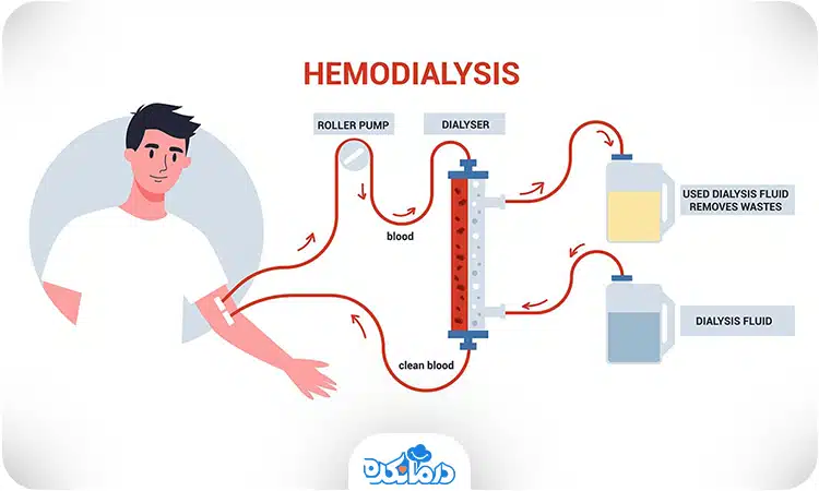 عکس نحوه همودیالیز.