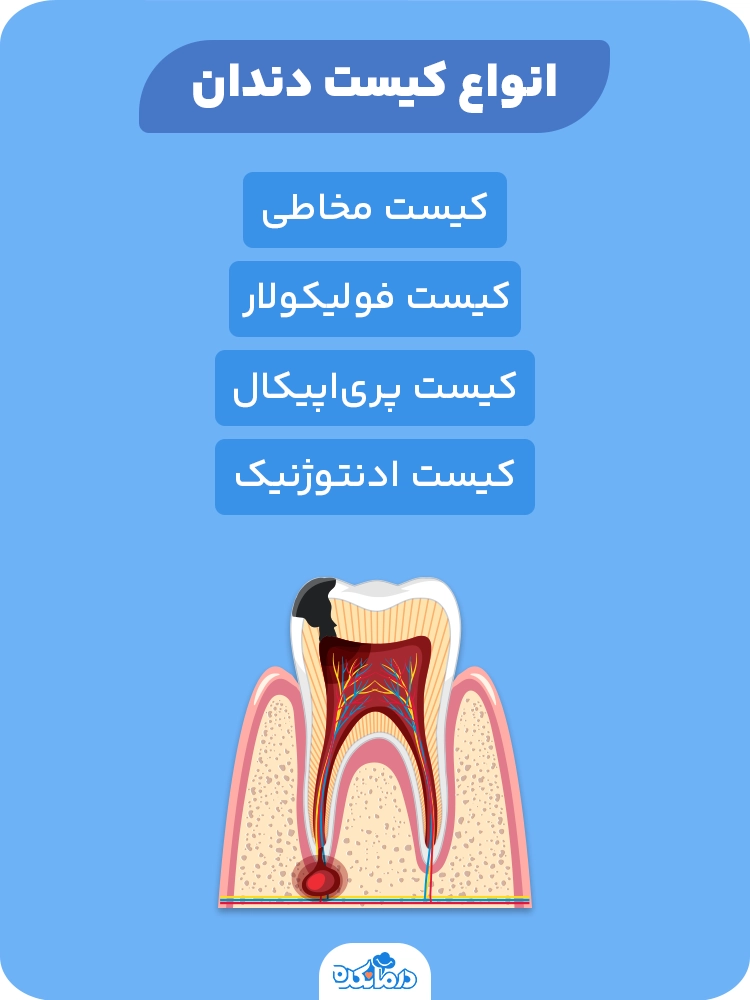 اینفوگرافی انواع کیست دندان