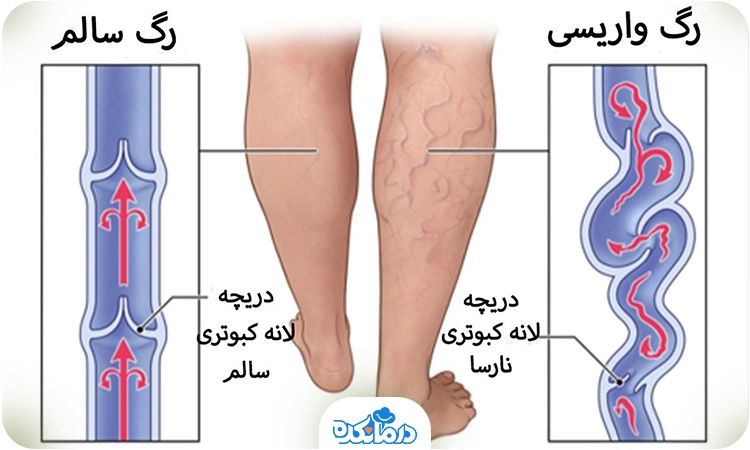 عکس دریچه‌های لانه کبوتری در سیاهرگ پا.