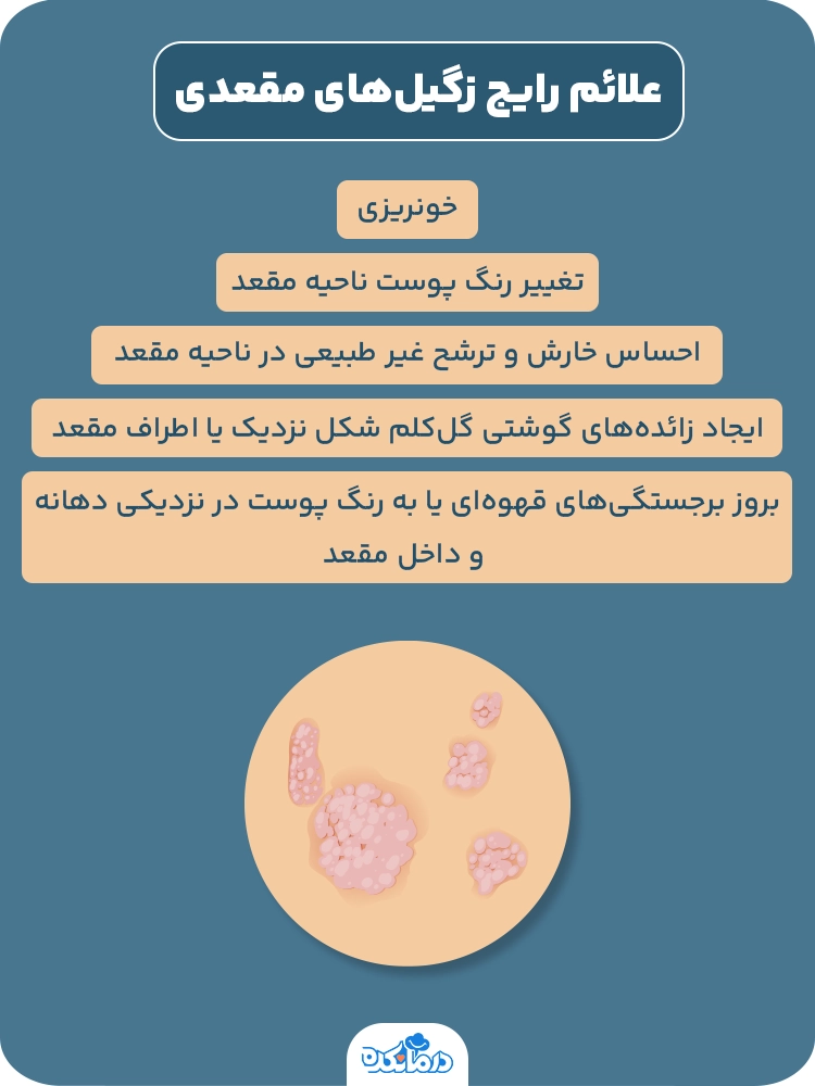 اینفوگرافیک علائم رایج زگیل‌های مقعدی