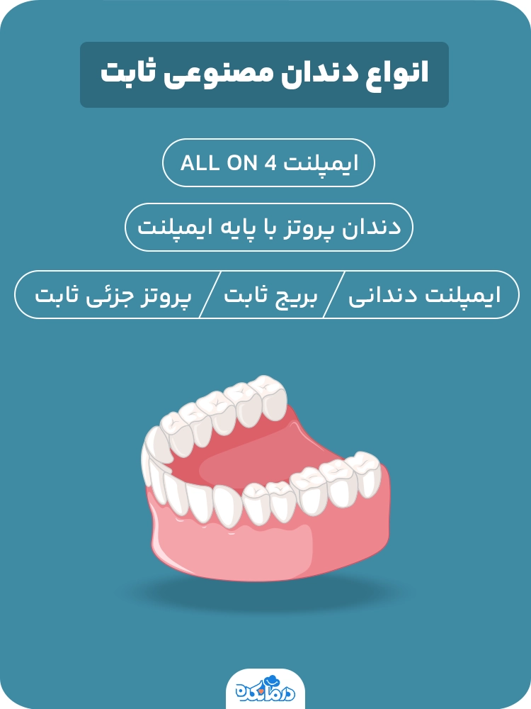 اینفوگرافی انواع دندان مصنوعی ثابت