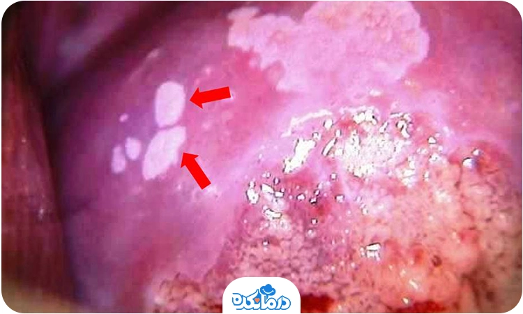  تصویری که علائم HPV را نشان می‌دهد.