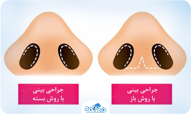 عکس تفاوت عمل رینوپلاستی باز و بسته.